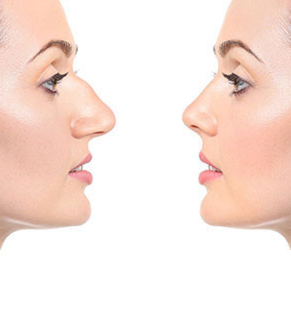 surgical_rhinoplasty_homepage